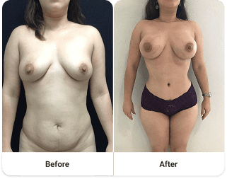 Before and after 2